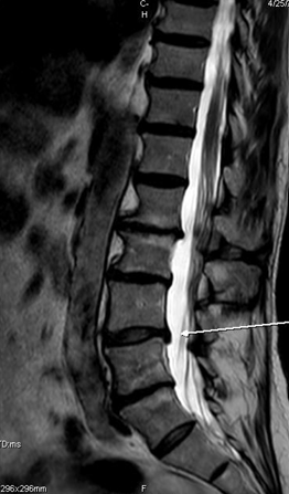Lumbar MRI from a case with report-confirmed annular fissures at multiple lumbar disc levels.