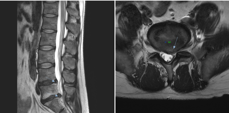 Lumbar MRI sagittal and axial views showing lower-lumbar disc extrusions at L4-L5 and L5-S1.