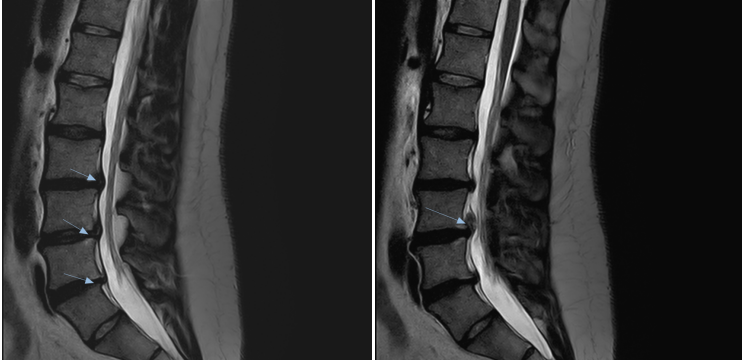 Lumbar MRI showing multiple disc extrusions at L2-L3, L3-L4 and L4-L5 with different relationships to the spinal canal and nerve roots.