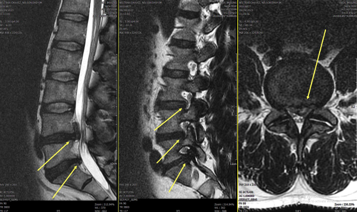 Before-and-after lumbar MRI showing interval reduction and remodeling of an L4-L5 disc extrusion from approximately 22 mm to approximately 10 mm.