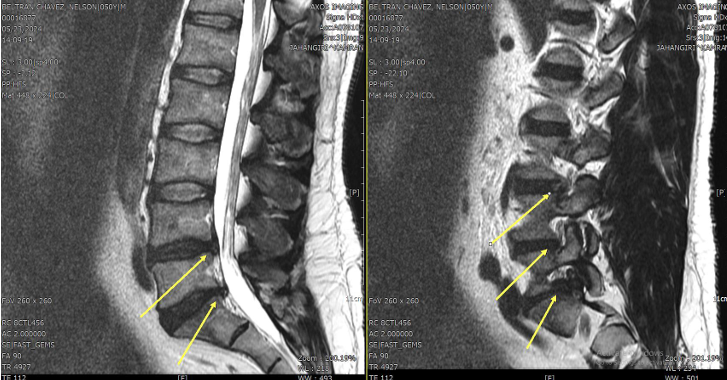 Before-and-after lumbar MRI showing interval reduction and remodeling of an L4-L5 disc extrusion from approximately 22 mm to approximately 10 mm.