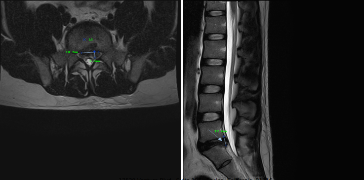 Lumbar MRI at L5-S1 showing disc extrusion with canal and foraminal nerve-root involvement.