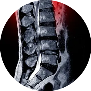 Spinal Stenosis Conditions Treatment in San Diego CA